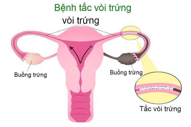 Tắc vòi trứng: nguyên nhân, chẩn đoán và điều trị