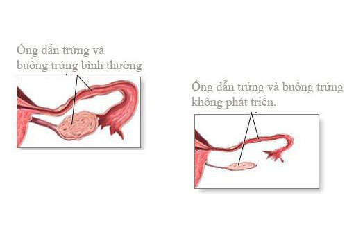 Teo buồng trứng và nguy cơ vô sinh nữ