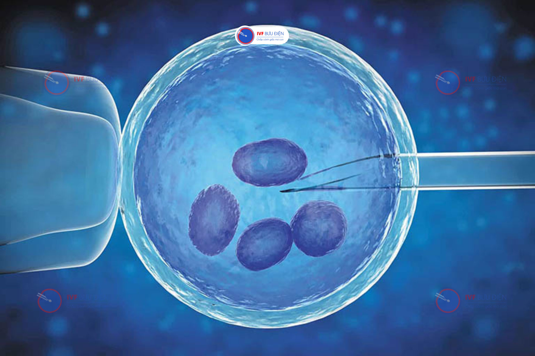 IVF là phương pháp hỗ trợ sinh sản có tỷ lệ mang thai cao