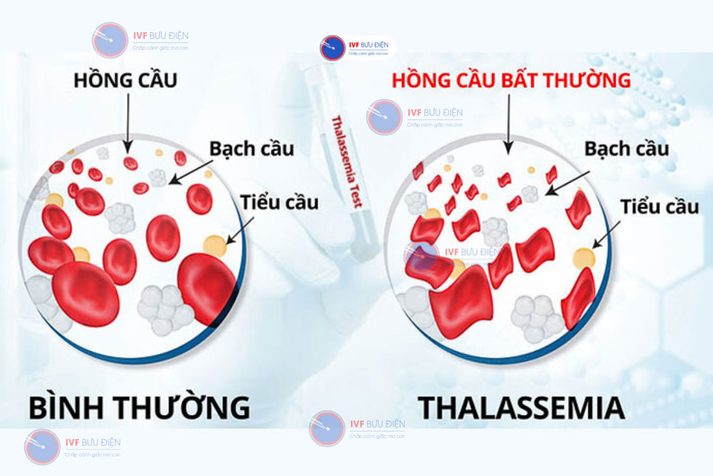 Hồng cầu của người bị bệnh Thalassemia