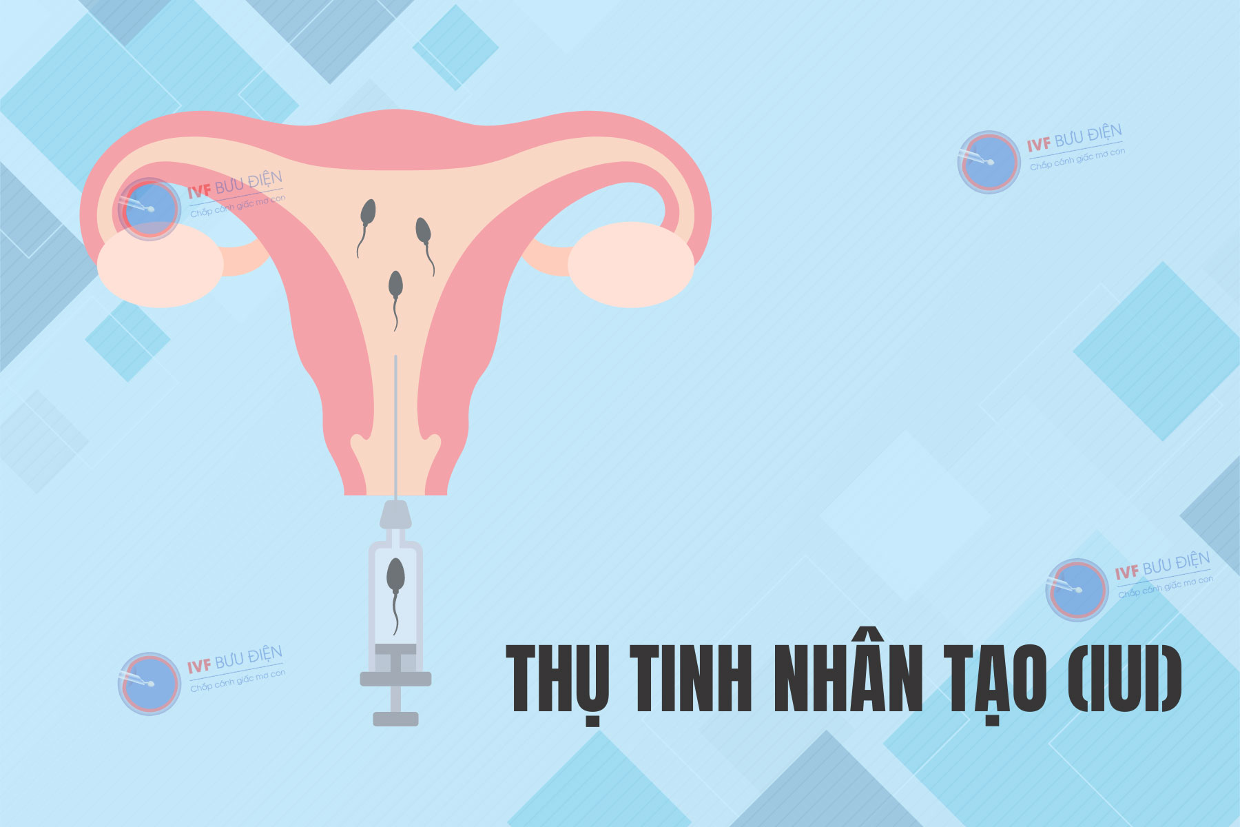 phương pháp thụ tinh nhân tạo bơm tinh trùng vào buồng tử cung