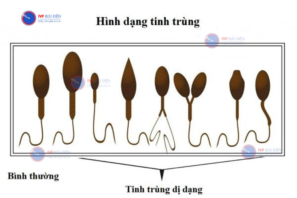 Tinh trùng dị dạng