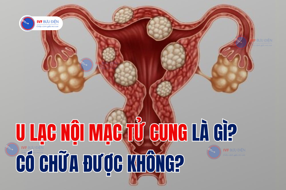 U lạc nội mạc tử cung là gì? Có chữa được không?