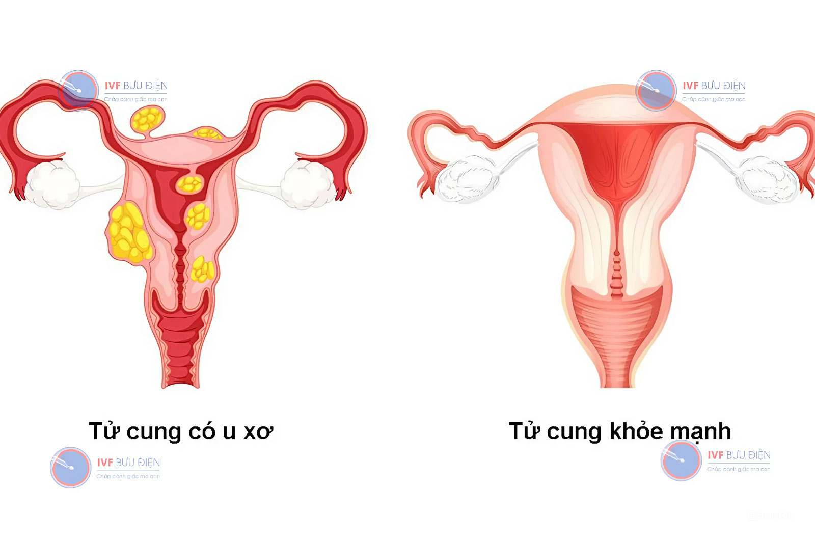 U xơ tử cung là bệnh lý thường gặp trong độ tuổi sinh sản của chị em phụ nữ. 