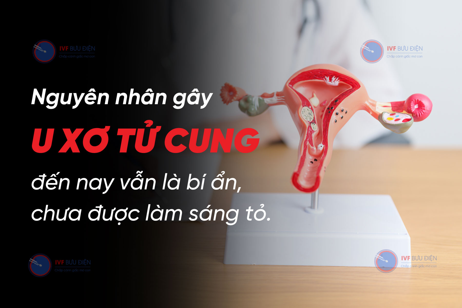 Nguyên nhân gây u xơ tử cung đến nay vẫn là bí ẩn, chưa được làm sáng tỏ.