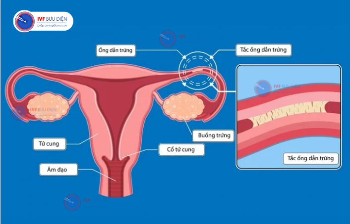 17 Năm Tìm Con Và Hành Trình Chữa Trị Cho Con Đầu Mắc Bại Não Thể Vận Động