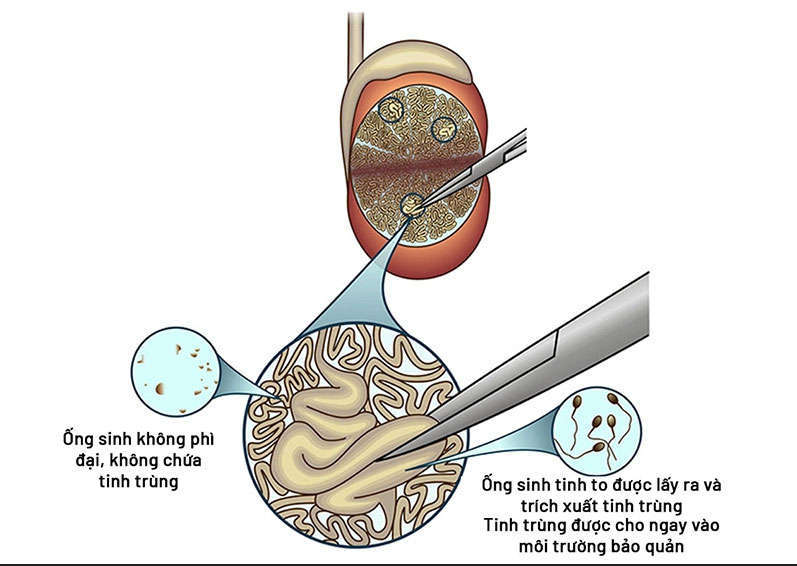 Lấy tinh trùng trong ống sinh tinh (Micro-TESE)