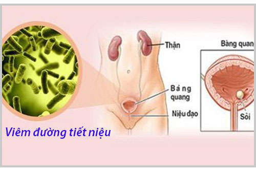 Nhiễm trùng đường tiết niệu ở nữ giới có nguy hiểm không?