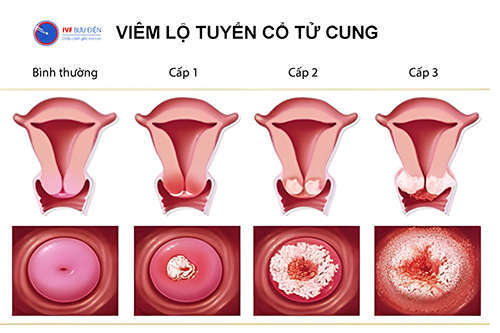 Hình ảnh viêm lộ tuyến cổ tử cung theo cấp độ