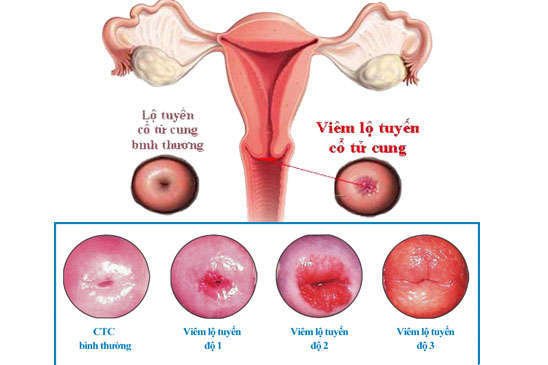 Viêm lộ tuyến cổ tử cung và những điều cần biết