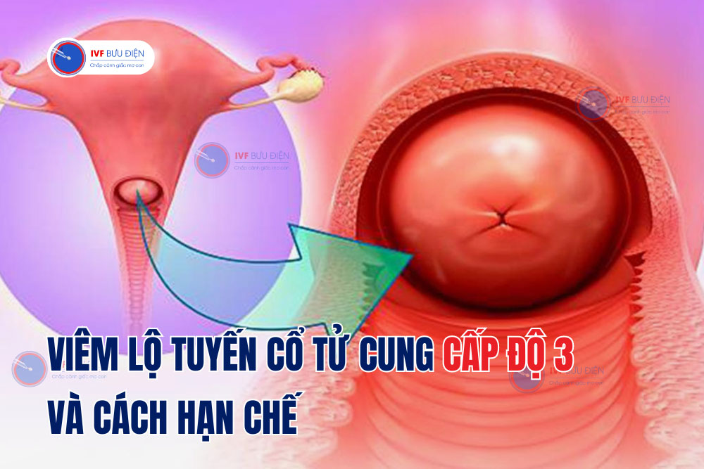 Viêm lộ tuyến cổ tử cung cấp độ 3 và cách hạn chế