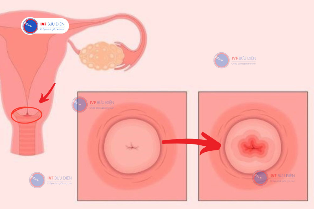 viêm lộ tuyến cổ tử cung cấp độ 3