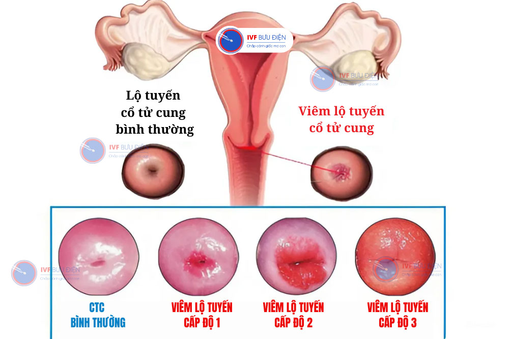 viêm lộ tuyến cổ tử cung các cấp độ