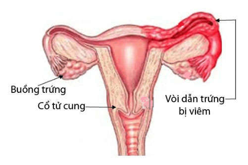 Viêm ống dẫn trứng có nguy hiểm không?